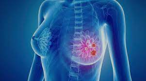 Рак молочної залози