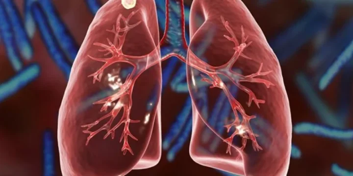 Туберкульоз: факти про захворювання, його симптоми, діагностика й лікування